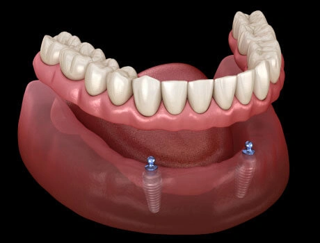 2 Dental Implant