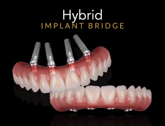 Hybrid Implant Bridge