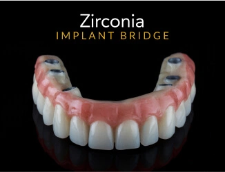 Zirconia Implant Bridge